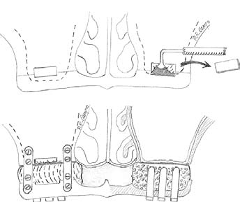  схематическое изображение методики: синус-лифтинг, остеотомия по Ле Фор I, фиксация мини-пластин и установка имплантатов