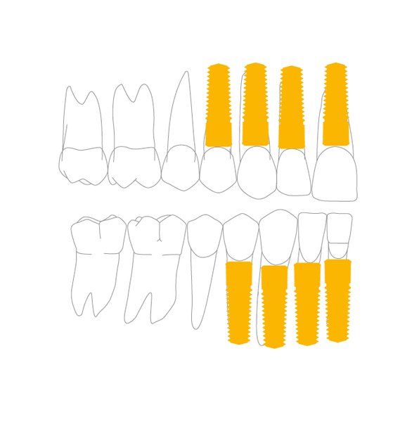 Позиция в зубном ряду для имплантата (3,8 мм)