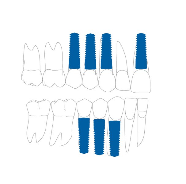 Position in the dental arch for the implant (4,5 mm)