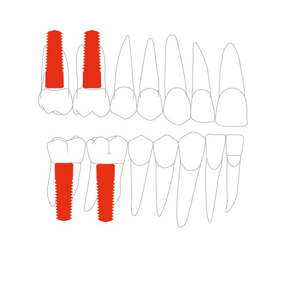 Позиция в зубном ряду для имплантата (5,5 мм)