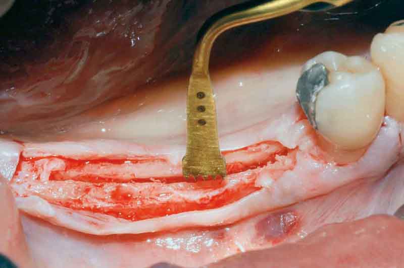 Расщепление альвеолярного гребня, метод кортикотомии, забор костного блока
