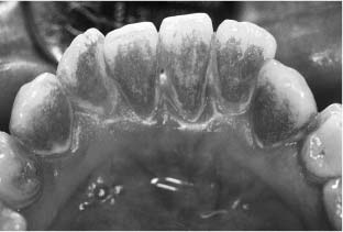 комплексное лечебно-профилактическое воздействие на зубы скейлером