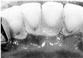 результат комплексного лечебно-профилактического воздействия на зубы